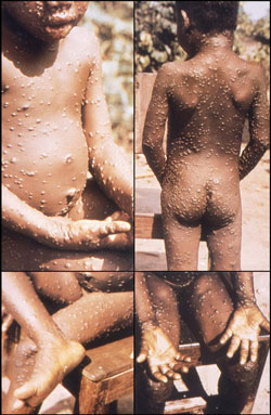 CDC證實亞城一旅客感染了猴痘，死亡率高達10%，無疫苗！